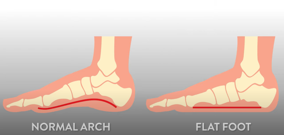 The 7 Best Nursing Shoes for Flat Feet: Factors to Consider - Ze Nurses