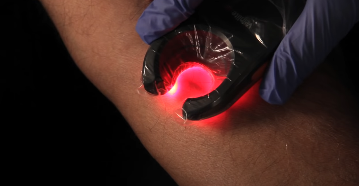 vein finder on patient